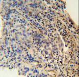 ZNF197 antibody immunohistochemistry of formalin-fixed and paraffin-embedded human lung carcinoma followed by peroxidase-conjugated secondary antibody and DAB staining.