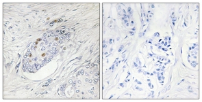 IHC of paraffin-embedded human breast carcinoma, using ZNF232 Antibody. The picture on the right is treated with the synthesized peptide.