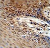 ZNF324B antibody immunohistochemistry of formalin-fixed and paraffin-embedded human skin carcinoma followed by peroxidase-conjugated secondary antibody and DAB staining.