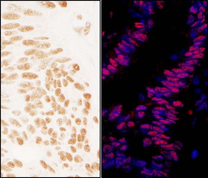 Detection of Human ZNF326 by Immunohistochemistry and Immunofluorescence. Sample: FFPE sections of human ovarian carcinoma (left) and colon carcinoma (right). Antibody: Affinity purified rabbit anti-ZNF326 used at a dilution of 1:1000 (0.2 ug/ml) and 1:400 (0.5 ug/ml). Detection: DAB and Red-fluorescent Goat anti-Rabbit IgG-heavy and light chain, cross-adsorbed Antibody DyLight 594 Conjugated used at a dilution of 1:100.
