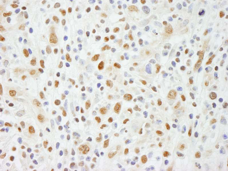Detection of Human NIF1 by Immunohistochemistry. Sample: FFPE section of human Hodgkin's lymphoma. Antibody: Affinity purified rabbit anti-NIF1 used at a dilution of 1:200 (1 ug/ml). Detection: DAB.