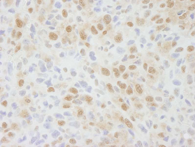 Detection of Mouse NIF1 by Immunohistochemistry. Sample: FFPE section of mouse squamous cell carcinoma. Antibody: Affinity purified rabbit anti-NIF1 used at a dilution of 1:250.