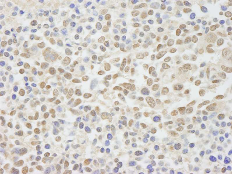 Detection of Human NIF1 by Immunohistochemistry. Sample: FFPE section of human non-small cell lung cancer. Antibody: Affinity purified rabbit anti-NIF1 used at a dilution of 1:250.