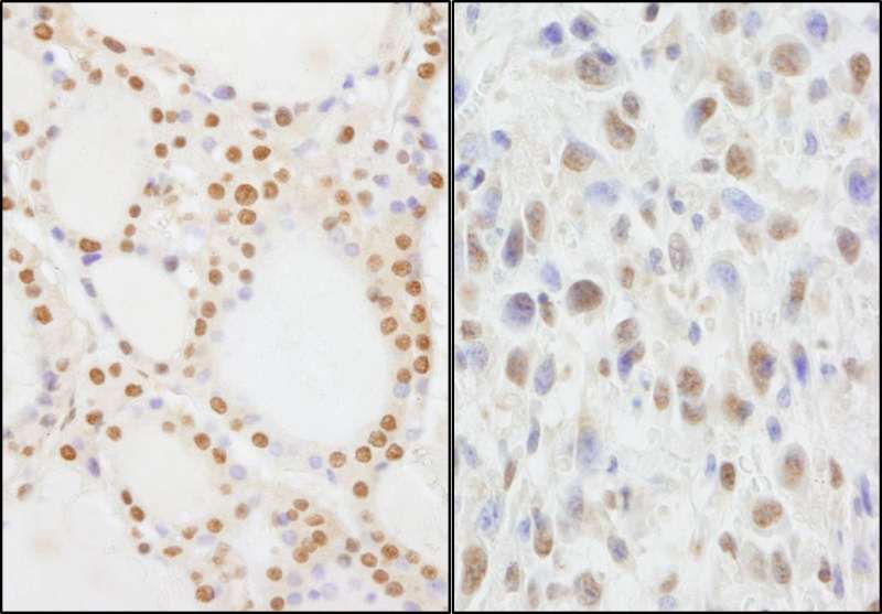 Detection of Human and Mouse NIF1 by Immunohistochemistry. Sample: FFPE section of human thyroid carcinoma (left) and mouse squamous cell carcinoma (right). Antibody: Affinity purified rabbit anti-NIF1 used at a dilution of 1:5000 (0.2 ug/ml). Detection: DAB.