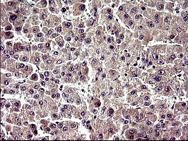 IHC of paraffin-embedded Carcinoma of Human liver tissue using anti-ZNF365 mouse monoclonal antibody. (Heat-induced epitope retrieval by 10mM citric buffer, pH6.0, 120°C for 3min).