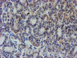 IHC of paraffin-embedded Carcinoma of Human thyroid tissue using anti-ZNF365 mouse monoclonal antibody. (Heat-induced epitope retrieval by 10mM citric buffer, pH6.0, 100C for 10min).