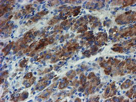 IHC of paraffin-embedded Carcinoma of Human liver tissue using anti-ZNF365 mouse monoclonal antibody. (Heat-induced epitope retrieval by 10mM citric buffer, pH6.0, 100C for 10min).