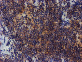 IHC of paraffin-embedded Human lymphoma tissue using anti-ZNF365 mouse monoclonal antibody.