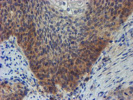 IHC of paraffin-embedded Carcinoma of Human bladder tissue using anti-ZNF365 mouse monoclonal antibody.