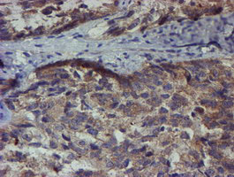 IHC of paraffin-embedded Adenocarcinoma of Human ovary tissue using anti-ZNF365 mouse monoclonal antibody.