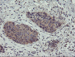 IHC of paraffin-embedded Carcinoma of Human lung tissue using anti-ZNF365 mouse monoclonal antibody.