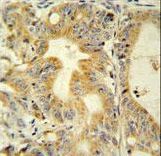 TNFRSF6B antibody immunohistochemistry of formalin-fixed and paraffin-embedded human colon carcinoma followed by peroxidase-conjugated secondary antibody and DAB staining.