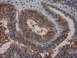 IHC of paraffin-embedded Adenocarcinoma of Human endometrium tissue using anti-HPGD mouse monoclonal antibody.