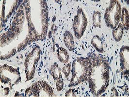 IHC of paraffin-embedded Carcinoma of Human prostate tissue using anti-HPGD mouse monoclonal antibody. (Heat-induced epitope retrieval by 10mM citric buffer, pH6.0, 100C for 10min).