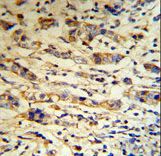 A1BG Antibody (RB18670) IHC of formalin-fixed and paraffin-embedded human breast carcinoma tissue followed by peroxidase-conjugated secondary antibody and DAB staining.