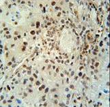 ABHEB Antibody immunohistochemistry of formalin-fixed and paraffin-embedded human lung carcinoma followed by peroxidase-conjugated secondary antibody and DAB staining.