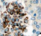 IHC of TRAcP on FFPE Hairy Cell Leukemia tissue.