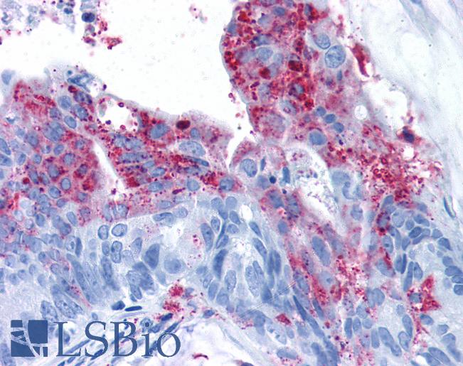 Anti-GPR124 / TEM5 antibody IHC of human Colon, Carcinoma. Immunohistochemistry of formalin-fixed, paraffin-embedded tissue after heat-induced antigen retrieval.
