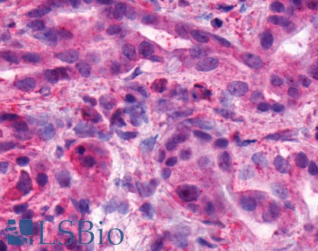 Anti-BAI1 antibody IHC of human Pancreas, Carcinoma. Immunohistochemistry of formalin-fixed, paraffin-embedded tissue after heat-induced antigen retrieval.