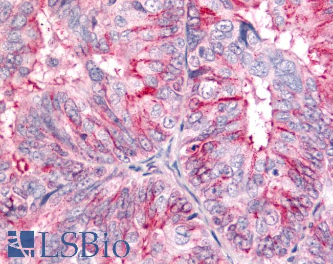 Anti-BAI2 antibody IHC of human Ovary, Carcinoma. Immunohistochemistry of formalin-fixed, paraffin-embedded tissue after heat-induced antigen retrieval.