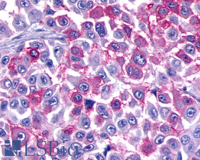 Anti-BAI3 antibody IHC of human Skin, Melanoma. Immunohistochemistry of formalin-fixed, paraffin-embedded tissue after heat-induced antigen retrieval.