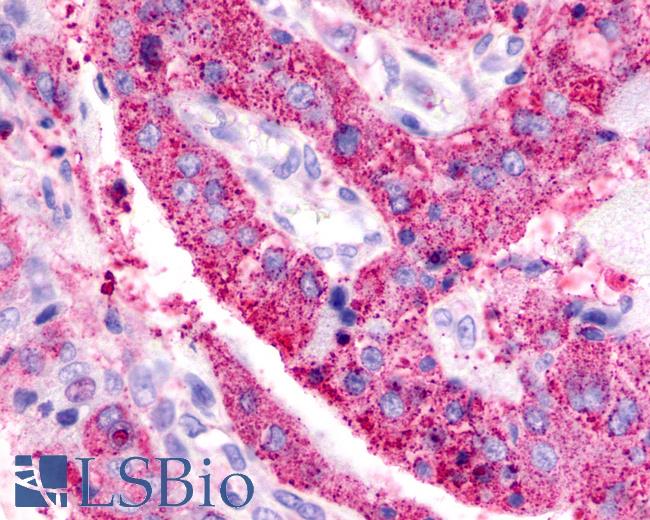 Anti-BAI3 antibody IHC of human Lung, Adenocarcinoma. Immunohistochemistry of formalin-fixed, paraffin-embedded tissue after heat-induced antigen retrieval.