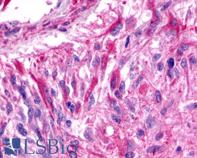 Anti-BAI3 antibody IHC of human Brain, Glioblastoma. Immunohistochemistry of formalin-fixed, paraffin-embedded tissue after heat-induced antigen retrieval.