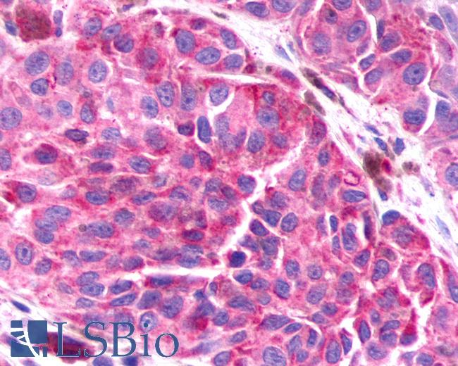 Anti-BAI3 antibody IHC of human Skin, Melanoma. Immunohistochemistry of formalin-fixed, paraffin-embedded tissue after heat-induced antigen retrieval.