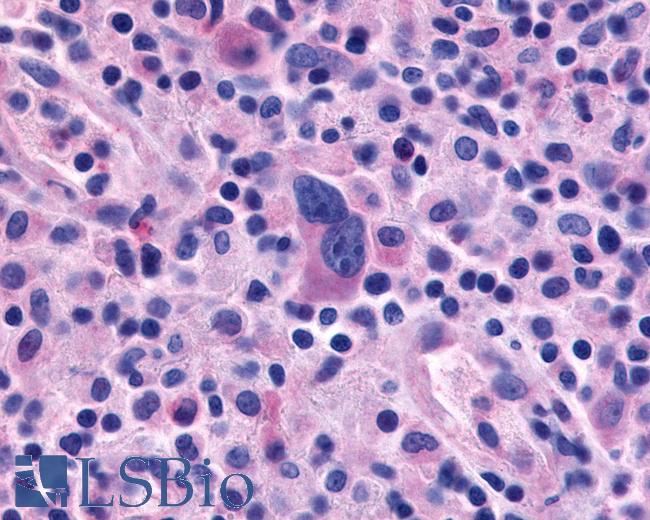 Anti-EMR1 / F4/80 antibody IHC of human Lymph Node, Hodgkins Lymphoma. Immunohistochemistry of formalin-fixed, paraffin-embedded tissue after heat-induced antigen retrieval.