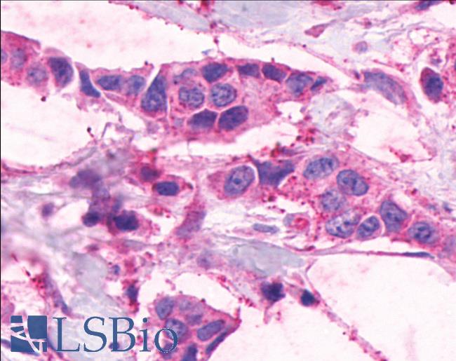 Anti-EMR1 / F4/80 antibody IHC of human Breast, Carcinoma. Immunohistochemistry of formalin-fixed, paraffin-embedded tissue after heat-induced antigen retrieval.