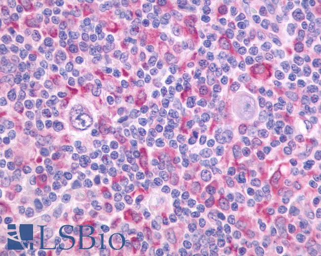 Anti-CD97 antibody IHC of human Lymph Node, Hodgkins Lymphoma. Immunohistochemistry of formalin-fixed, paraffin-embedded tissue after heat-induced antigen retrieval.