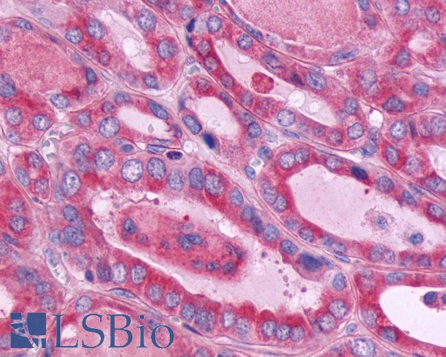 Anti-CD97 antibody IHC of human Thyroid, Follicular Carcinoma. Immunohistochemistry of formalin-fixed, paraffin-embedded tissue after heat-induced antigen retrieval.