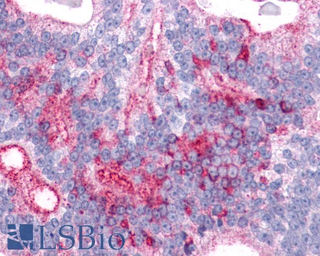 Anti-LPHN2 / Latrophilin-2 antibody IHC of human prostate, carcinoma. Immunohistochemistry of formalin-fixed, paraffin-embedded tissue after heat-induced antigen retrieval.