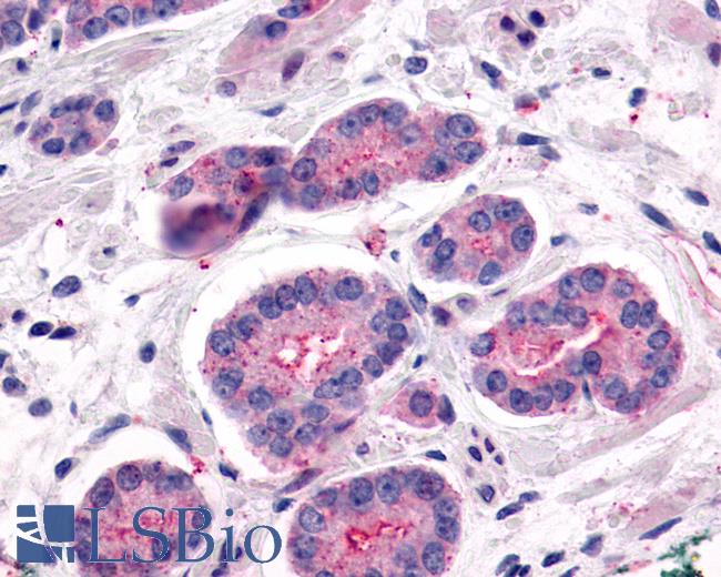 Anti-LPHN2 / Latrophilin-2 antibody IHC of human Prostate, Carcinoma. Immunohistochemistry of formalin-fixed, paraffin-embedded tissue after heat-induced antigen retrieval.