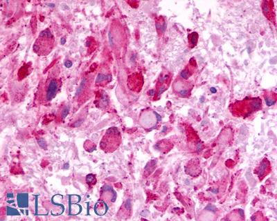 Anti-LPHN3 / Latrophilin-3 antibody IHC of human Brain, Glioblastoma. Immunohistochemistry of formalin-fixed, paraffin-embedded tissue after heat-induced antigen retrieval.