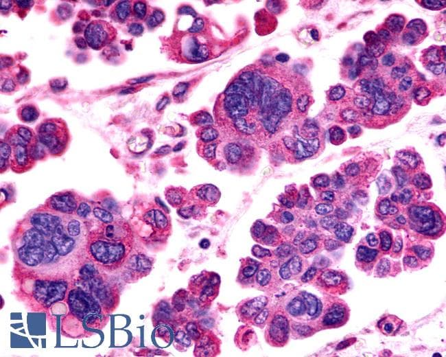 Anti-GPR98 / VLGR1 antibody IHC of human Ovary, Carcinoma. Immunohistochemistry of formalin-fixed, paraffin-embedded tissue after heat-induced antigen retrieval.