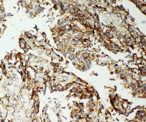 AIFM1 / AIF antibody. IHC(P): Human Lung Cancer Tissue.