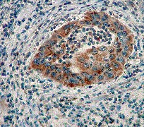 IHC of paraffin-embedded human cervical carcinoma using anti-AIF antibody.