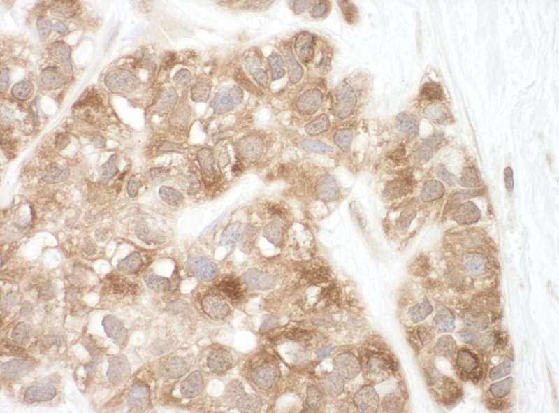 Detection of Human AIF by Immunohistochemistry. Sample: FFPE section of human breast carcinoma. Antibody: Affinity purified rabbit anti-AIF used at a dilution of 1:200 (1 ug/ml).