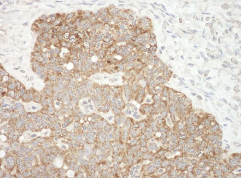 Detection of Human AIF by Immunohistochemistry. Sample: FFPE section of human ovarian carcinoma. Antibody: Affinity purified rabbit anti-AIF used at a dilution of 1:1000 (1 ug/mg).