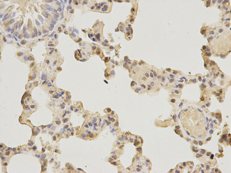 Immunohistochemistry of paraffin-embedded mouse esophageal cancer using AIFM1 antibody at dilution of 1:200 (200x lens).