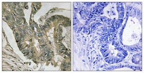 IHC of paraffin-embedded human colon carcinoma tissue, using ALDOC Antibody. The picture on the right is treated with the synthesized peptide.