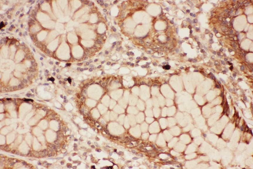 ALOX15 antibody IHC-paraffin: Human Intestine Cancer Tissue.