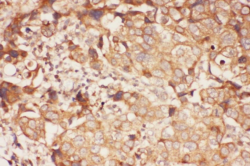 ALOX15 antibody IHC-paraffin: Human Mammary Cancer Tissue.