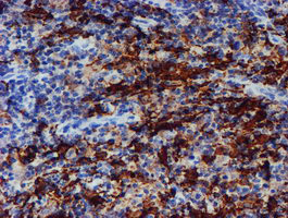 IHC of paraffin-embedded Human lymphoma tissue using anti-ALOX15 mouse monoclonal antibody.