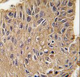 Formalin-fixed and paraffin-embedded human lung carcinoma tissue reacted with ANTXR1 Antibody (Y382) , which was peroxidase-conjugated to the secondary antibody, followed by DAB staining. This data demonstrates the use of this antibody for immunohistochemistry; clinical relevance has not been evaluated.