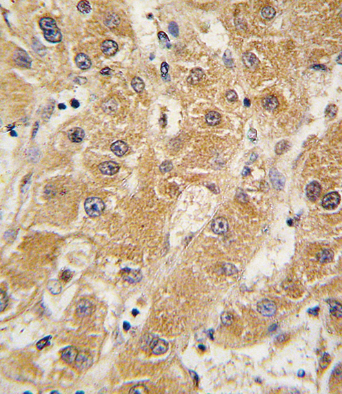 Formalin-fixed and paraffin-embedded human hepatocarcinoma tissue reacted with APOA5 antibody , which was peroxidase-conjugated to the secondary antibody, followed by DAB staining. This data demonstrates the use of this antibody for immunohistochemistry; clinical relevance has not been evaluated.