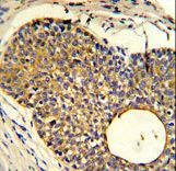 Formalin-fixed and paraffin-embedded human prostate carcinoma reacted with PHO1 Antibody , which was peroxidase-conjugated to the secondary antibody, followed by DAB staining. This data demonstrates the use of this antibody for immunohistochemistry; clinical relevance has not been evaluated.