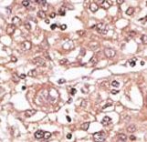 Formalin-fixed and paraffin-embedded human cancer tissue reacted with the primary antibody, which was peroxidase-conjugated to the secondary antibody, followed by AEC staining. This data demonstrates the use of this antibody for immunohistochemistry; clinical relevance has not been evaluated. BC = breast carcinoma; HC = hepatocarcinoma.