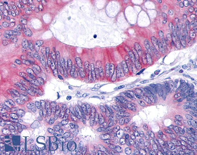 Anti-TNIK antibody IHC of human Colon, Carcinoma. Immunohistochemistry of formalin-fixed, paraffin-embedded tissue after heat-induced antigen retrieval.
